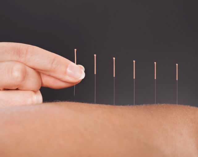 Traditional Chinese Acupuncture | CōLAB Health & Body | Chiropractic & Wellness Clinic | Downtown Calgary, AB